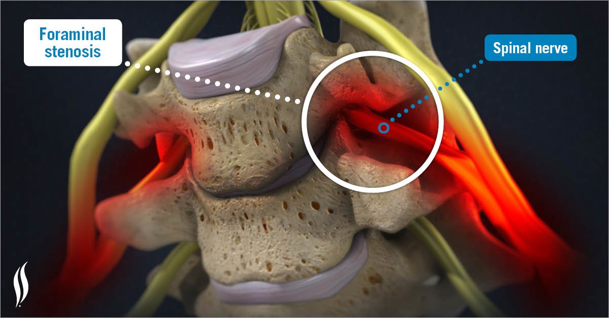 Qu Est Ce Qu Une Stenose Foraminale - Image to u