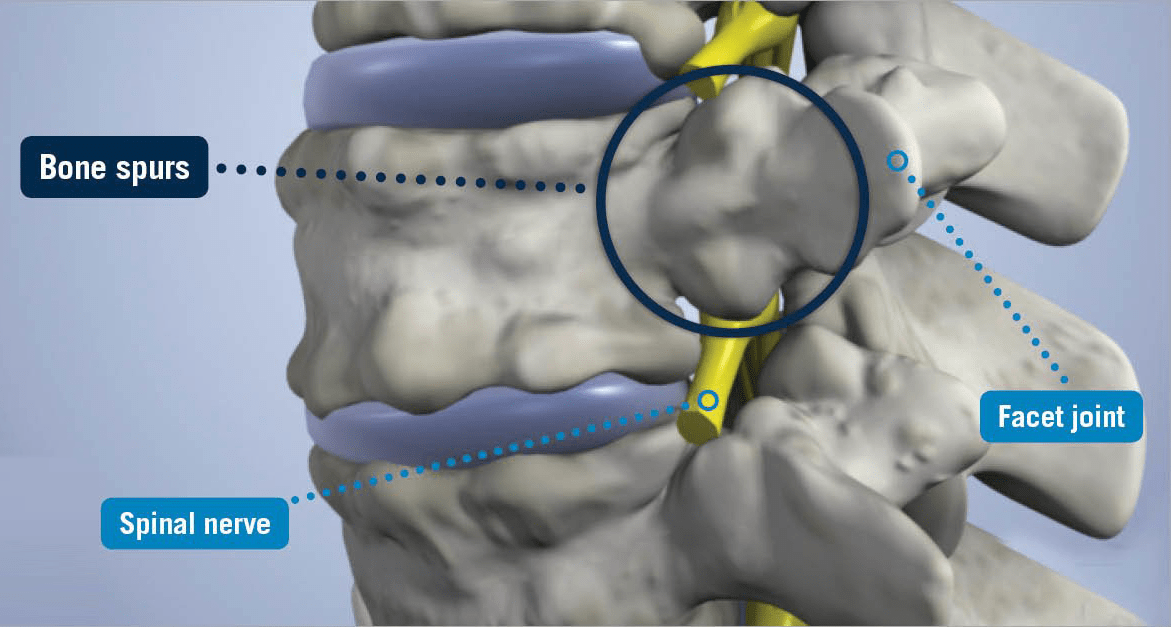 Bone Spurs - USA Spine Care - Laser Spine Surgery