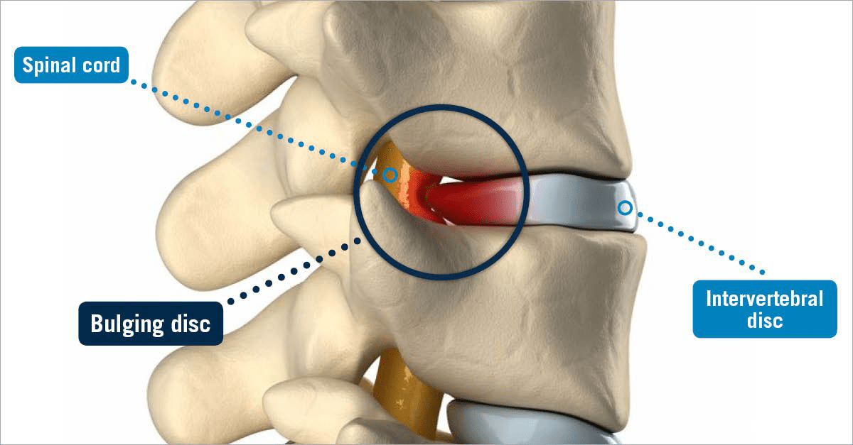 Bulging Disc USA Spine Care Laser Spine Surgery