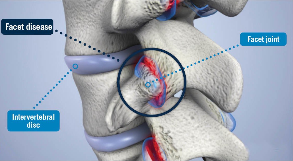 Facet Disease USA Spine Care Laser Spine Surgery