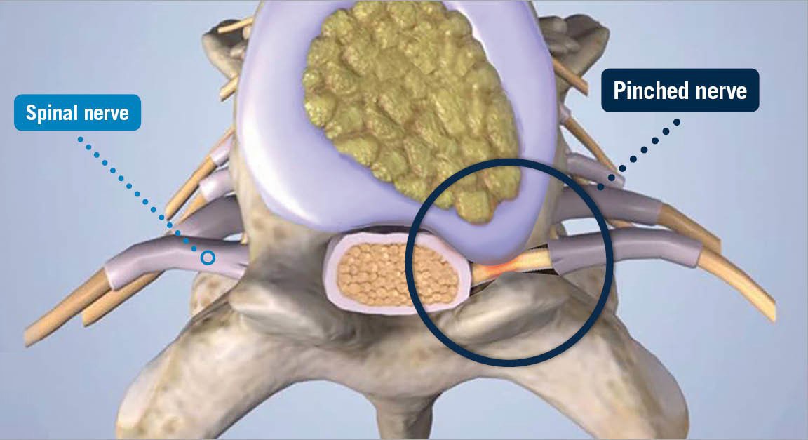 Pinched Nerve USA Spine Care Laser Spine Surgery