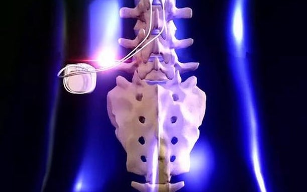 Spinal Cord Stimulator for San Antonio, TX