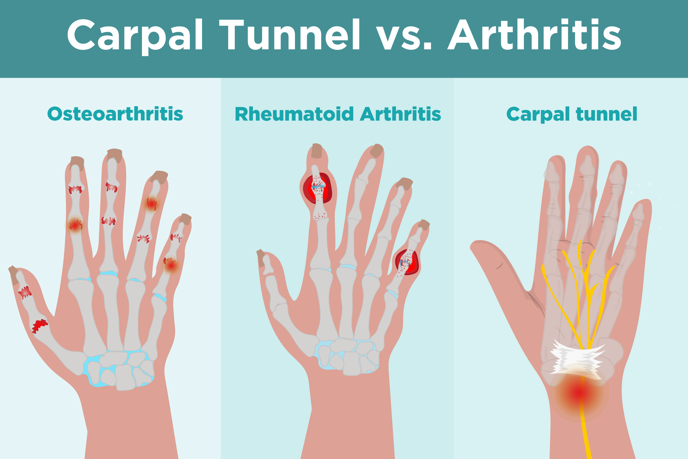 Osteoarthritis Rheumatoid Arthritis Of The Wrist USASC Orthopedics