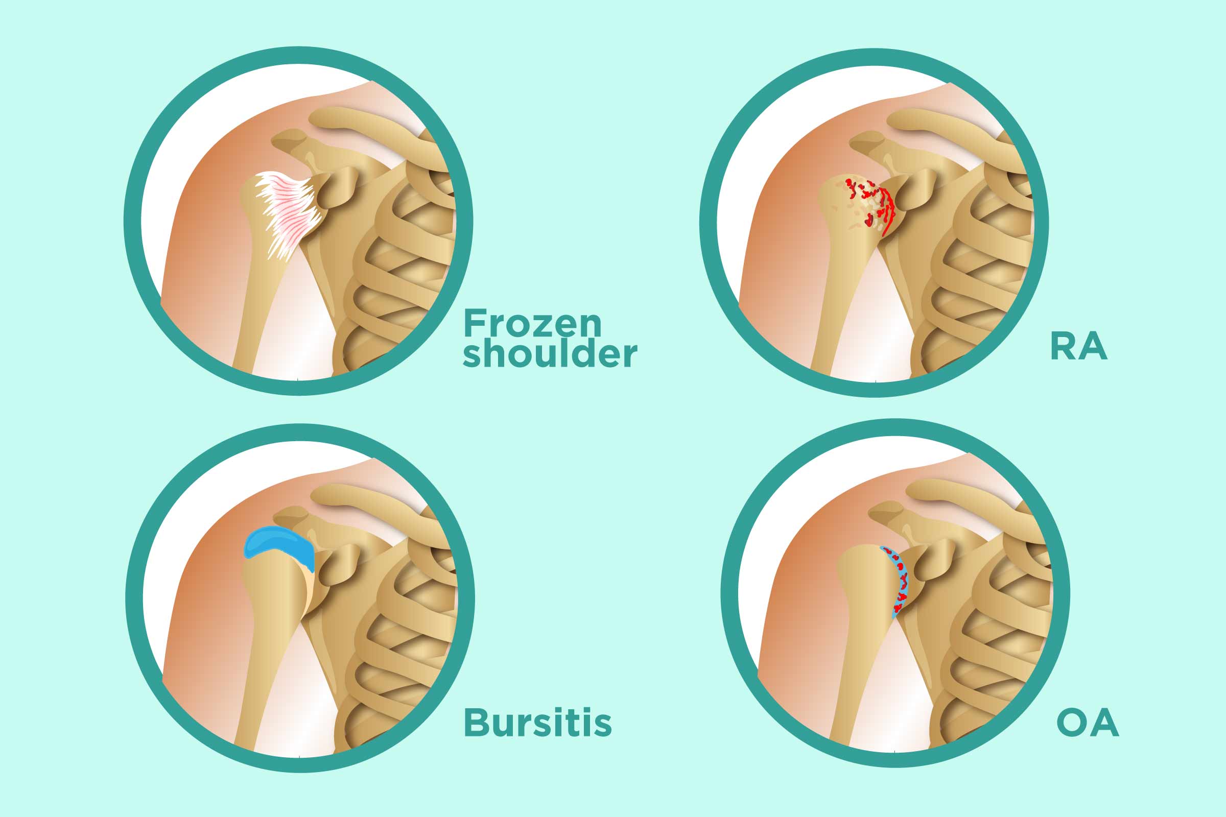 Rheumatoid Arthritis Of The Shoulder USA Spine Care Orthopedics