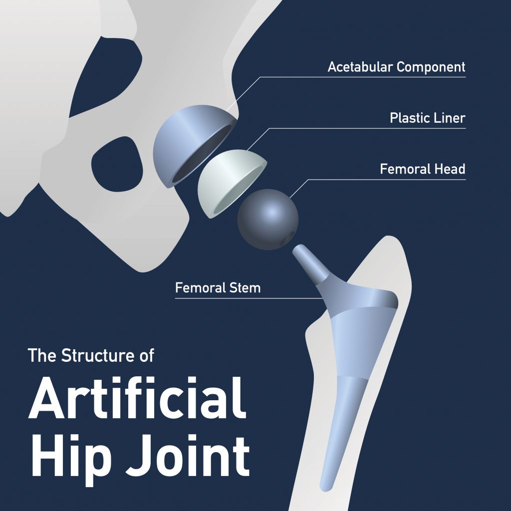 partial-hip-replacement-vs-total-hip-replacement-usa-spine-ortho