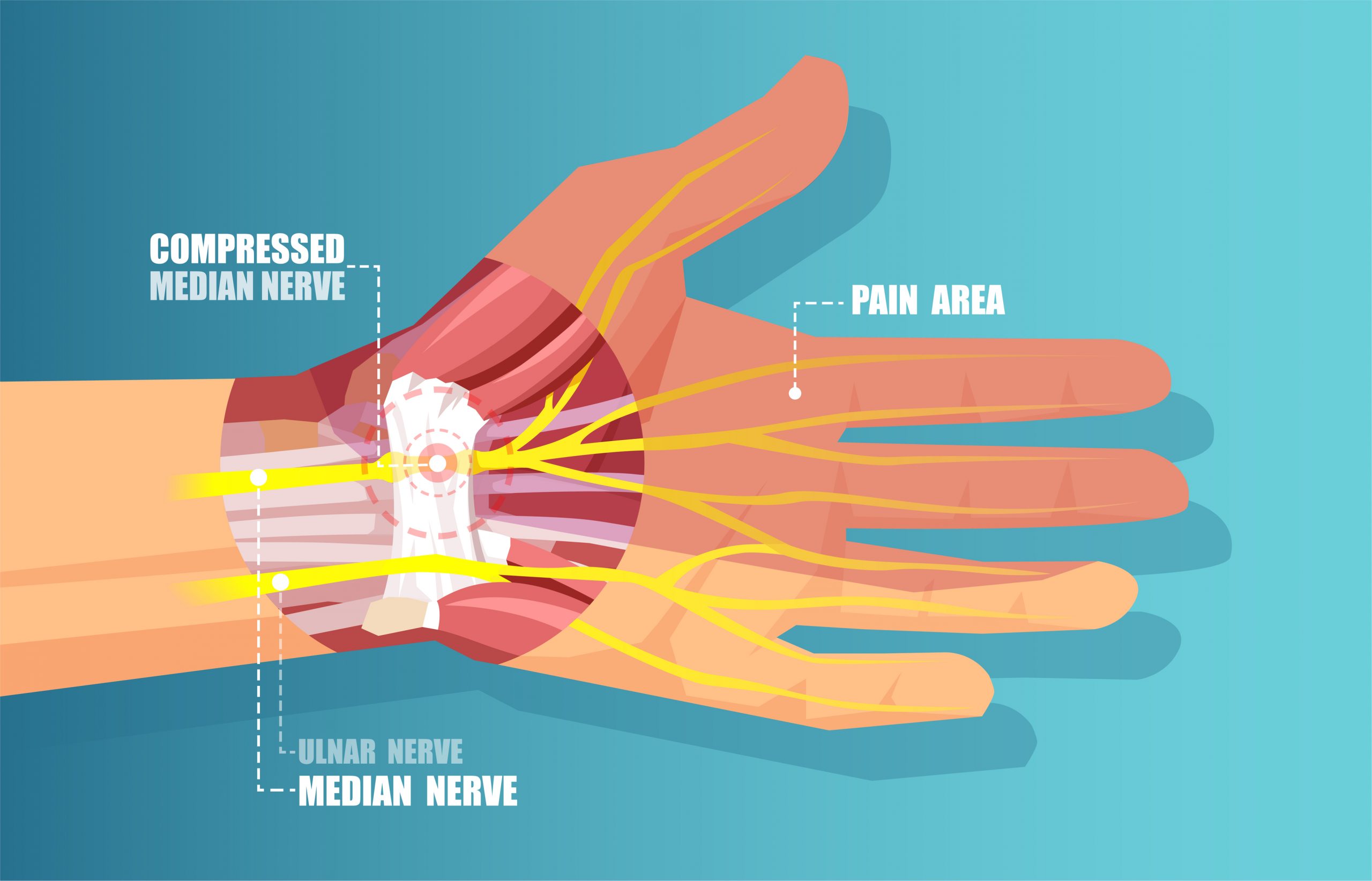 How Do You Get A Wrist Ligament Tear USA Spine Care Orthopedics