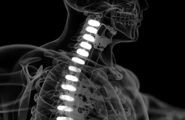 Diagnosing Syringomyelia