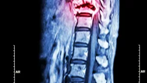 Managing Pain Associated with Syringomyelia