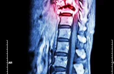 Managing Pain Associated with Syringomyelia