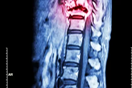 Managing Pain Associated with Syringomyelia