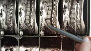 The Economic Impact of Biportal Endoscopic Spine Surgery (BESS)